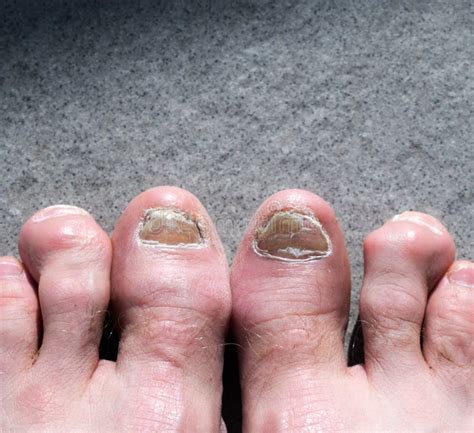 ugly feet pics|Ugly Feet Stock Photos, Images & Pictures